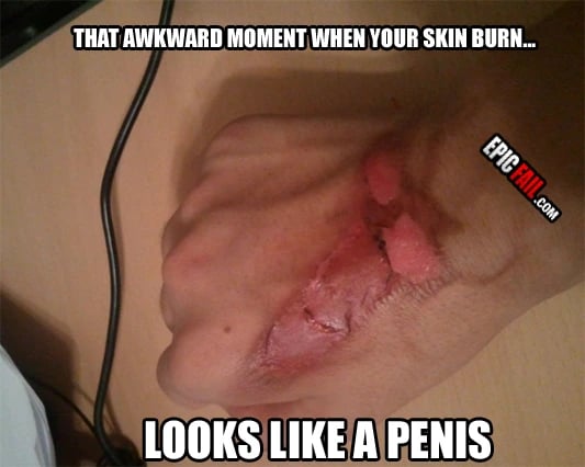 Moment: epic Skin Burn Fail