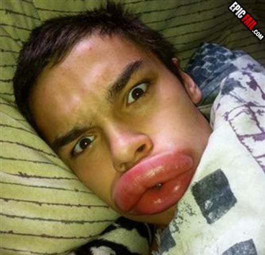 Scene: epic Lip Enhancement Fail