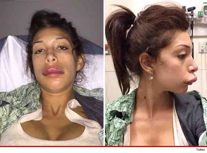 Farrah Abraham's Botched Lip Surgery — fail moment